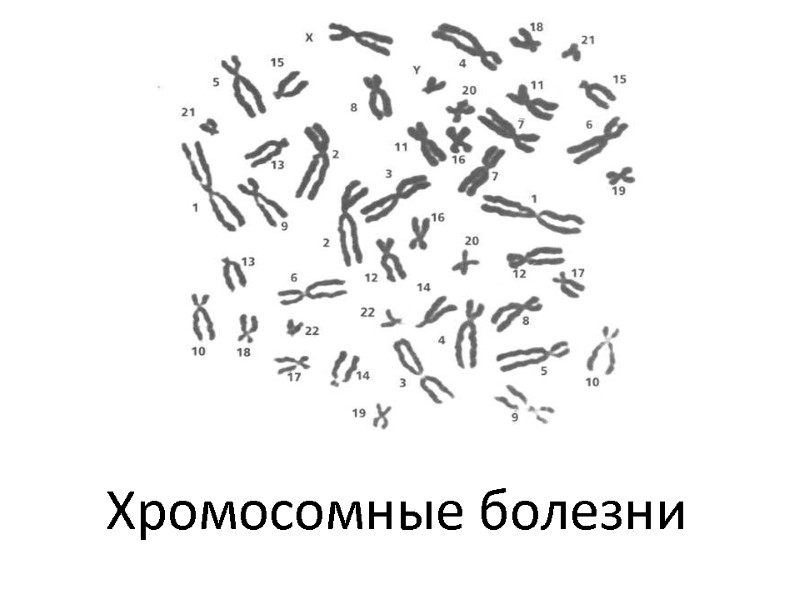Хромосомные болезни